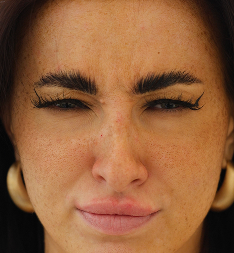 After anti-wrinkle treatment for frown lines