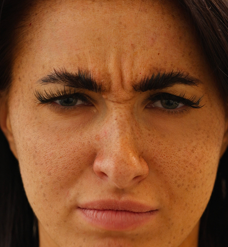 Before anti-wrinkle treatment for frown lines
